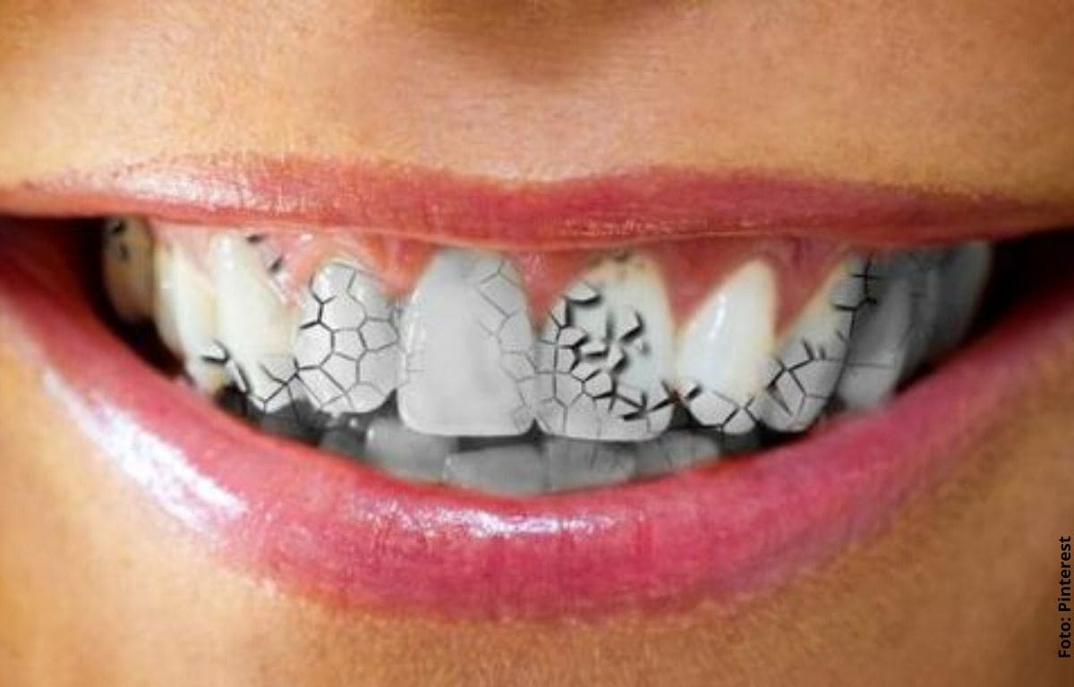 dientes con fisuras